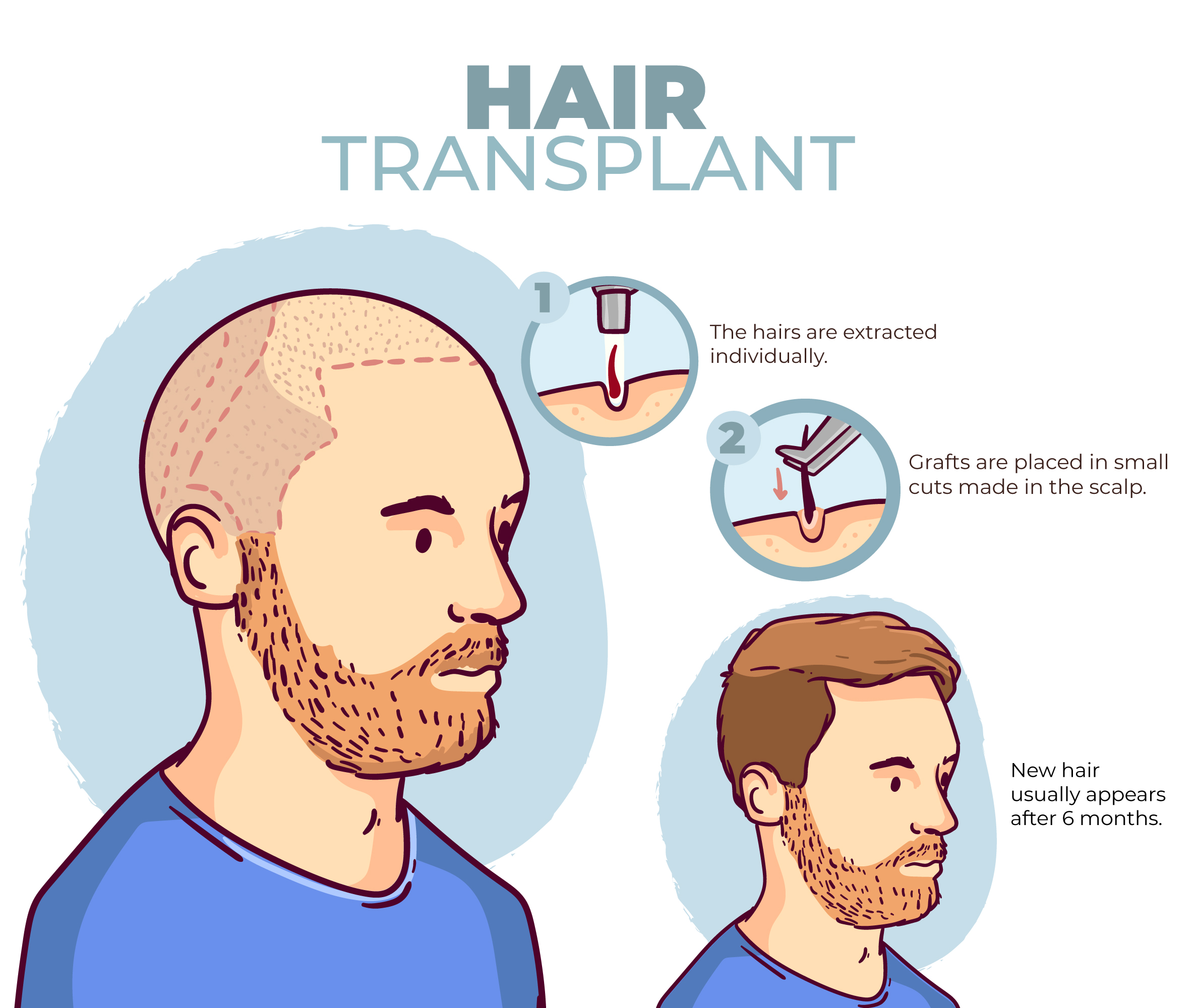 What is a Hair Transplant?